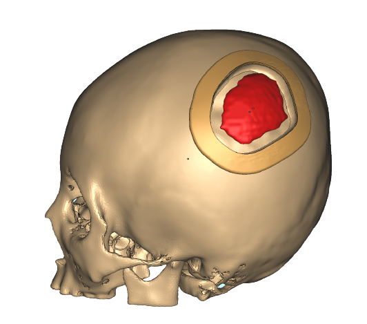 Empowering PEEK Implant Surgeries with INTAMSYS 3D Printing Technology